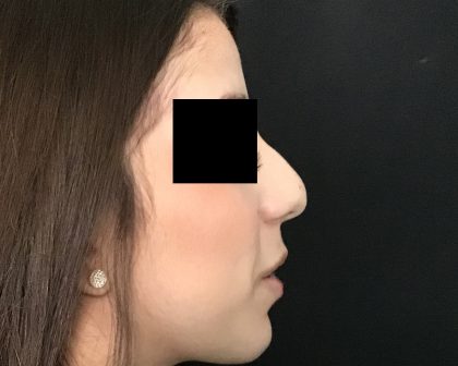 Rhinoplasty Before & After Patient #2050