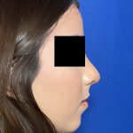 Rhinoplasty Before & After Patient #2050