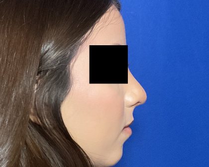 Rhinoplasty Before & After Patient #2050