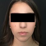 Rhinoplasty Before & After Patient #2050
