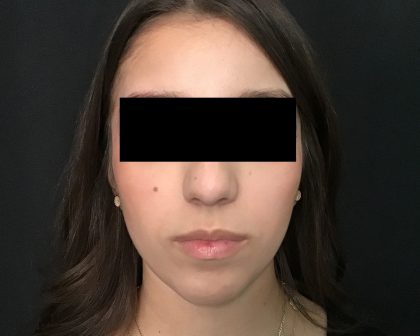 Rhinoplasty Before & After Patient #2050