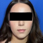 Rhinoplasty Before & After Patient #2050