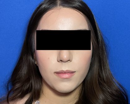 Rhinoplasty Before & After Patient #2050