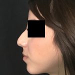 Rhinoplasty Before & After Patient #2050
