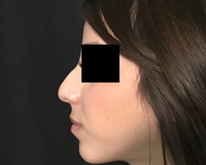 Rhinoplasty Before & After Patient #2050