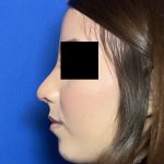 Rhinoplasty Before & After Patient #2050