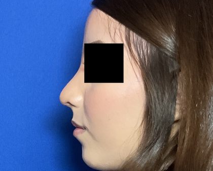 Rhinoplasty Before & After Patient #2050